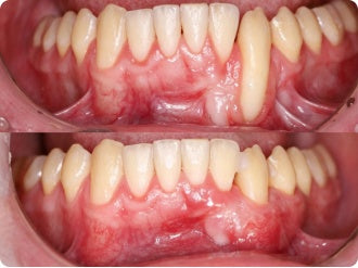 Customer-submitted before and after gum care images
